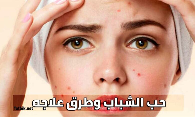 حب الشباب